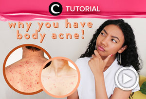 Kupas tuntas apa saja penyebab dan faktor utama dari munculnya body acne di : https://bit.ly/2BRRFeO. Video ini di-share kembali oleh Clozetter @juliahadi. Lihat juga tutorial lainnya yang ada di Tutorial Section.