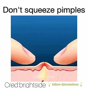 #acne #pimples #clozetteid