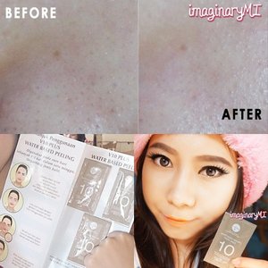 Byebye komedo & kulit mati 😁😁
thanks @v10plus_indonesia for the amazing peeling 😍😘
Read the review 👉 http://imaginarymi.blogspot.com ✨ 
#clozetteid #review #beautyblogger #skincare #peeling #selfie