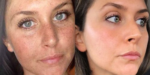 This Woman’s Before-And-After Sun Damage Photo Is Going Viral