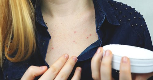 The Dermatologist-Approved Way to Treat Chest Acne Once and For All