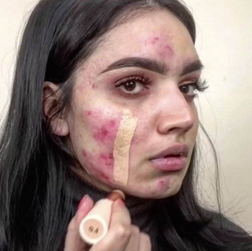 This drugstore foundation stick completely covered up a beauty vlogger's acne in one swipe