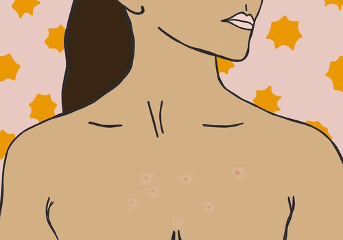 How to prevent annoying chest acne during a sticky, hot summer