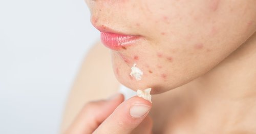 So You Popped That Pimple — Now What?