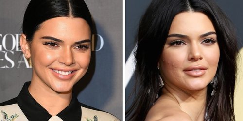 People Think Kendall Jenner Had Lip Injections at the Golden Globes Thanks to These Pics