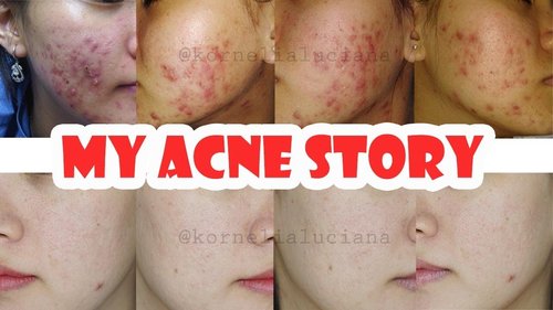 My Acne Story | Perjuangan Melawan Jerawat | Skincare Untuk Kulit Berjerawat | Revisi - YouTube