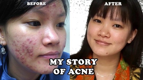 My Acne Story 