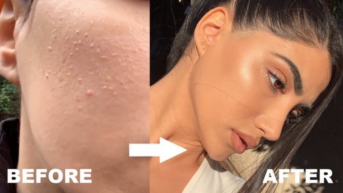 HOW I GOT RID OF STUBBORN BUMPS AND TEXTURED SKIN - YouTube