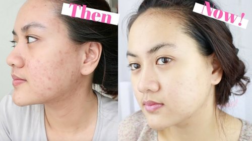 BANTU PUDAR KAN BEKAS JERAWAT - Updated Acne Skincare Routine + Praktek Pemakaian - YouTube