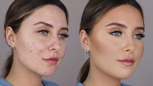 HOW TO COVER ACNE SCARS *easy & non cakey* - YouTube