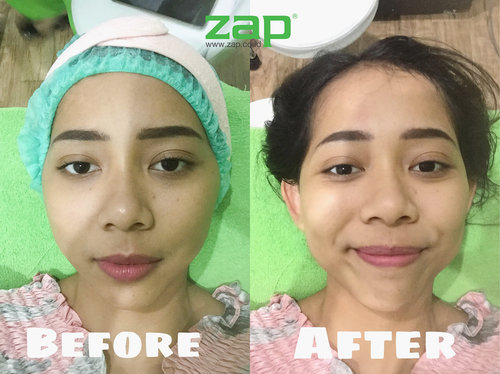 Heyo Beauties! 💖So, several days ago, I’ve tried New ZAP Photo Facial Treatment in @zaplotte •You can see the result on the picture! I also make a #VLOGGY 7: Facial Tanpa Sakit di ZAP Clinic on my YouTube channel: Christy Raina (link on bio) ✨•Overall, I love the result! My skin becomes brighter and smoother—and it’s painless. Wanna know more about the treatment? Go check my video on YouTube yaaa! 🤗💛•#cantikjamannow #clozetteid #zaptestimonial #discoveryourconfidence