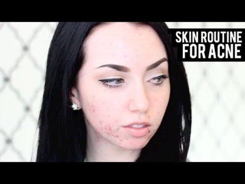 SKINCARE ROUTINE FOR ACNE PRONE SKIN + MY ACNE STORY - YouTube