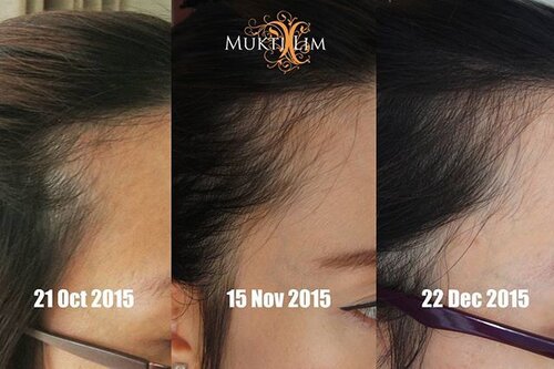 Mana yang botak??? Ini lhoo kepala depan.. kanan kiri pula... ini yang sisi kiri...mendingan kan di bulan ketiga ... #hair #hairtreatment #scalp #scalpessence #hairserum #hairloss #beauty #beautyblogger #beautybloggerindonesia #bblogger #bblog #blogger #vlogger #indonesiabeautyblogger #clozette #clozetteid #clozettebeauty #ibb #like #like4like #likeforlike