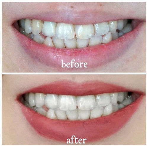 Look at the before after of using @hismileteeth consecutively for 6 days. The teeth are clearly whiten and thorough. The white tone is even and gives me an extra clean feeling too. #HiSmile #Smile #Teethwhitening @Hismileteeth #motd #ootd #bblogger #blogger #clozetteid #love #beautybloggerindonesia