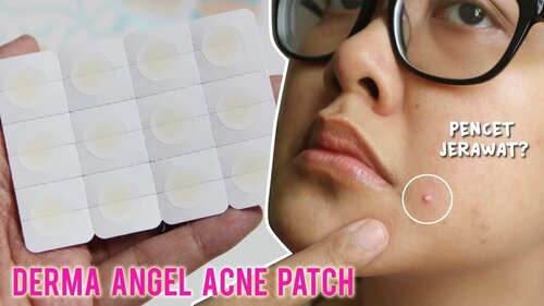 Jerawat Jangan Dipencet! Pakai Derma Angel Acne Patch aja  - YouTube