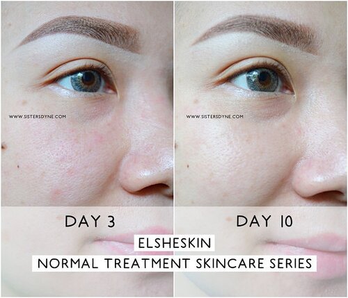 Sebelum dan Sesudah pemakaian product @elsheskin ?? Cari lah perbedaanya, ditunggu di collom commemt yaaa 😘
.
Cek review detail product @elsheskin di link bio or www.sistersdyne.com
.
#Clozette #Clozetteid #Beauty #Skincare #Cosmetics #FacialWash #Toner #Daycream #Nightcream #normalskin #skintype #flawless #radiant #bloggerreview #bbloggers #beautybloggeid #instabeauty #instagood #instaskincare #dasistersblog #bloggers #bokeh #treatment