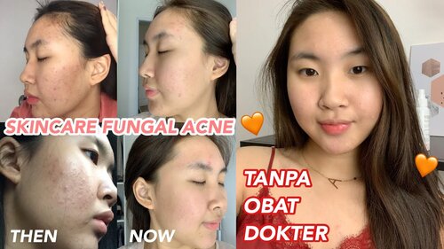 MY ACNE STORY + SKINCARE ROUTINE UNTUK FUNGAL ACNE (BERUNTUSAN) TANPA OBAT DOKTER! Indonesia - YouTube